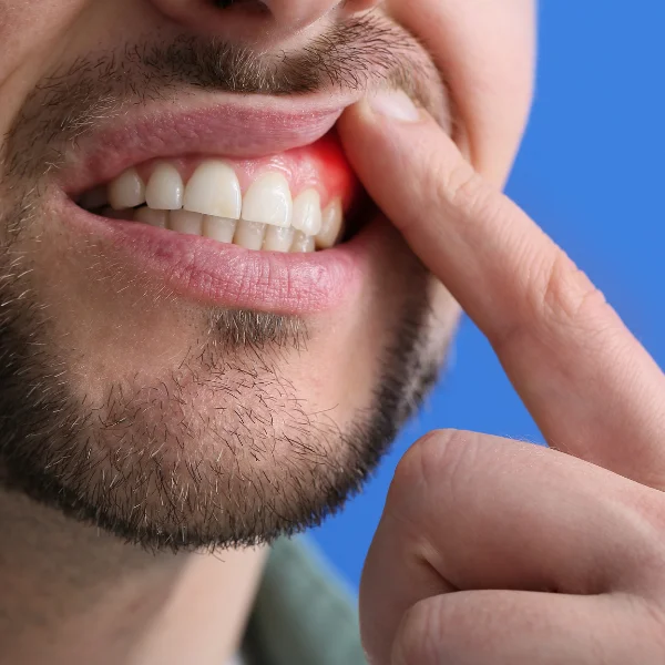 Periodontal Care